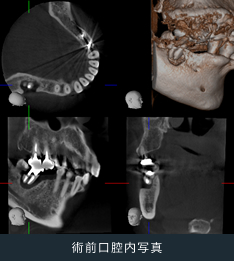 顎骨炎症搔爬術 診療内容 筑波口腔外科