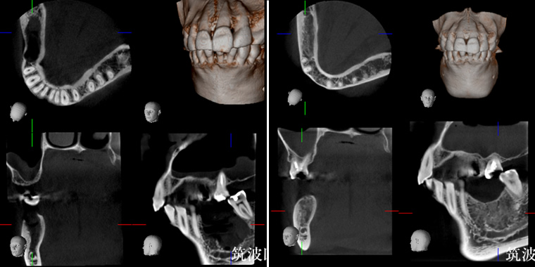 顎骨再生術（アテロコラーゲン・FGF）歯槽骨・顎骨再生