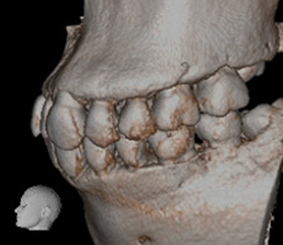 正常左臼歯部
