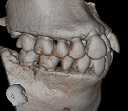 正常右臼歯部