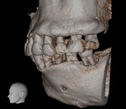 中度左臼歯部